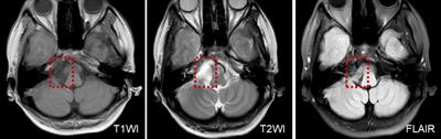 The Spectrum of Vestibular Disorders Presenting With Acute Continuous Vertigo